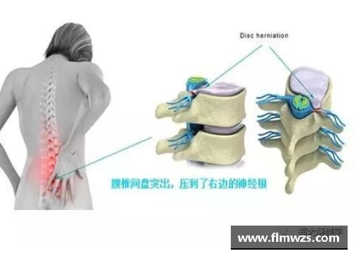 球速体育NBA球员腰椎间盘突出：症状、治疗及预防策略
